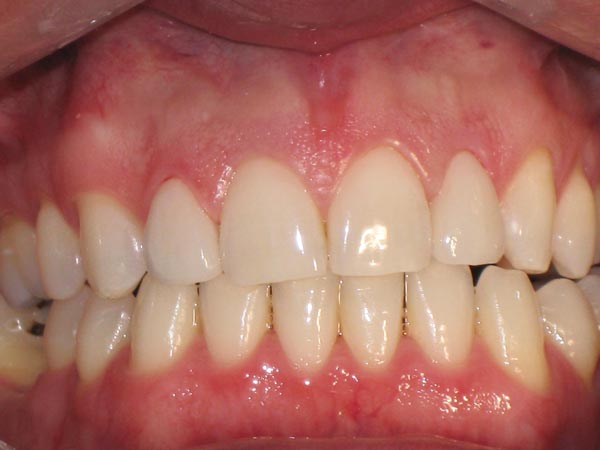 Ceramic veneers on incisors