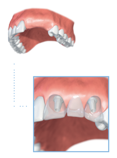 Multiple Teeth Implant