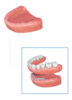 Dentures 