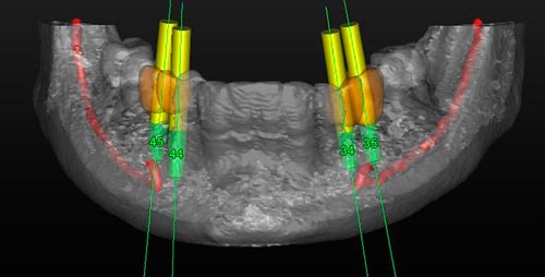 Clinical Application Of Computer Guided Implant Surgery